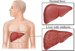 cirrhosis of the liver