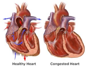 congestive heart failure