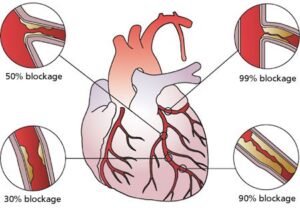 coronary artery disease