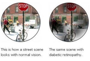 diabetic retinopathy eye