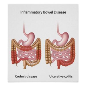 inflammatory bowel disease ibd