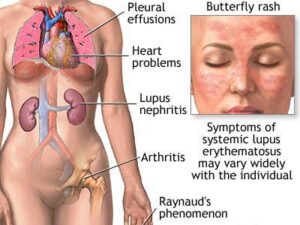 lupus
