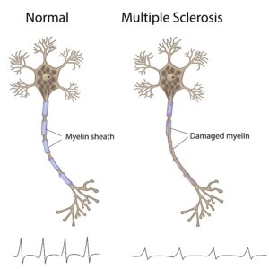 multiple sclerosis effects