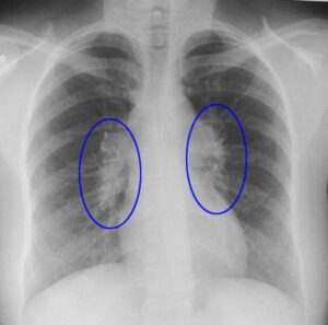 sarcoidosis