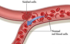 sicklecell blockage