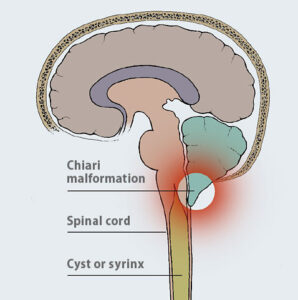 syringomyelia chiari malformation diagram